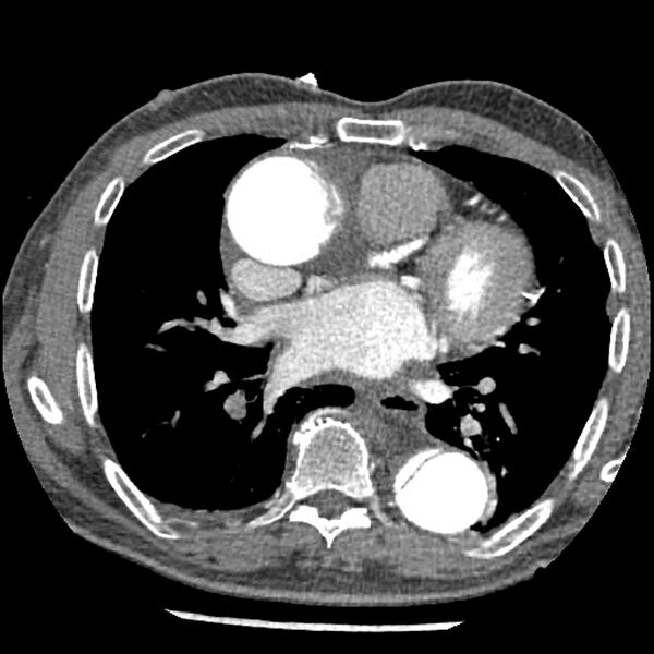 File:Aortic dissection - DeBakey Type I-Stanford A (Radiopaedia 79863-93115 A 21).jpg