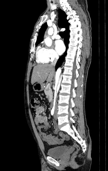 File:Aortic dissection - Stanford type A (Radiopaedia 83418-98500 B 27).jpg