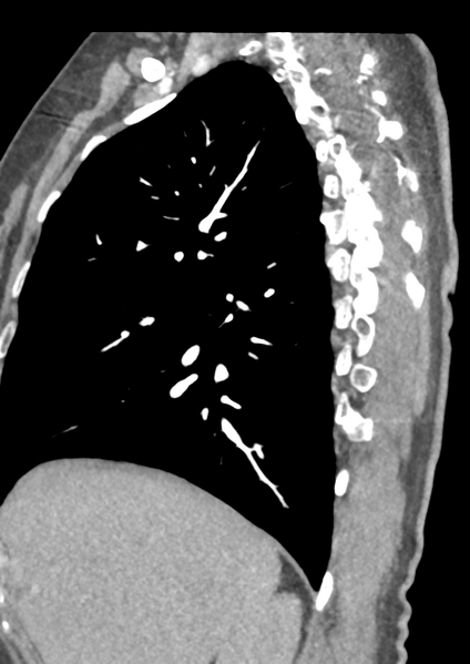 File:Aortic dissection - Stanford type B (Radiopaedia 50171-55512 C 51).png