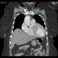 Aortic valve stenosis (Radiopaedia 14480-14423 A 2).jpg