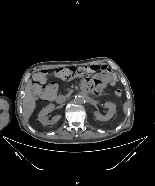 File:Aortoenteric fistula (Radiopaedia 84308-99603 Axial non-contrast 111).jpg