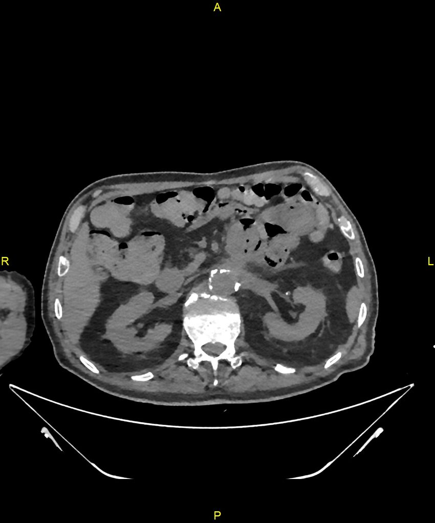 Aortoenteric fistula (Radiopaedia 84308-99603 Axial non-contrast 111).jpg