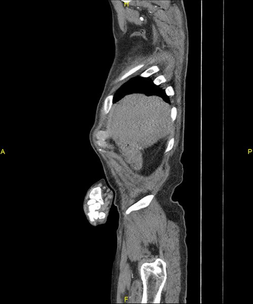 File:Aortoenteric fistula (Radiopaedia 84308-99603 C 36).jpg