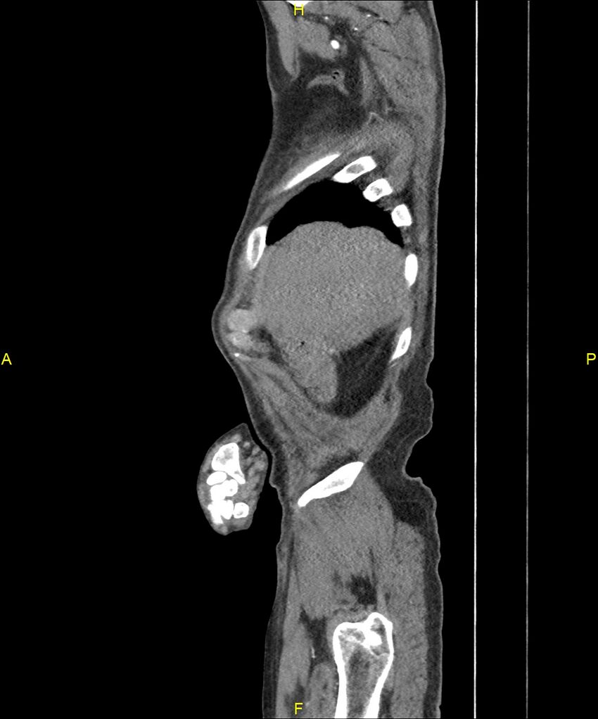 Aortoenteric fistula (Radiopaedia 84308-99603 C 36).jpg