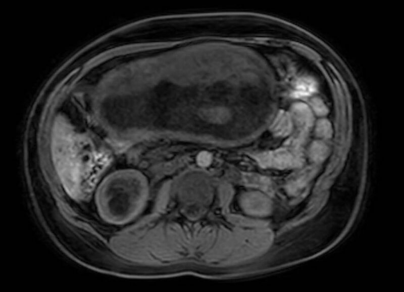 File:Appendicitis in gravida (MRI) (Radiopaedia 89433-106395 Axial DIXON 60).jpg