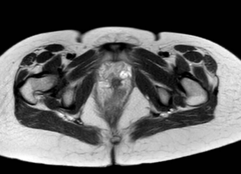 File:Appendicitis in gravida (MRI) (Radiopaedia 89433-106395 Axial T2 70).jpg