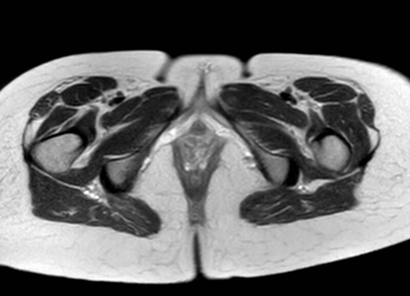File:Appendicitis in gravida (MRI) (Radiopaedia 89433-106395 Axial T2 74).jpg