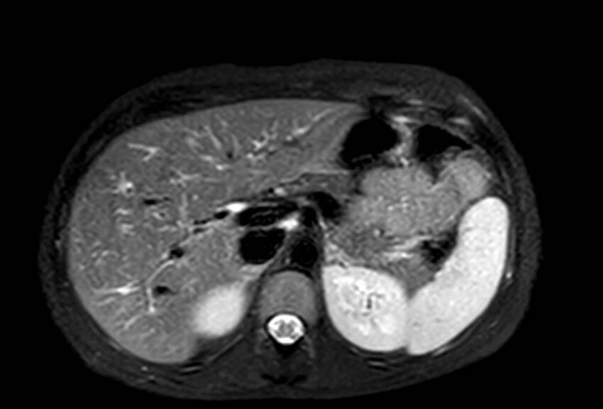 Appendicitis in gravida (MRI) (Radiopaedia 89433-106395 Axial T2 SPAIR 20).jpg