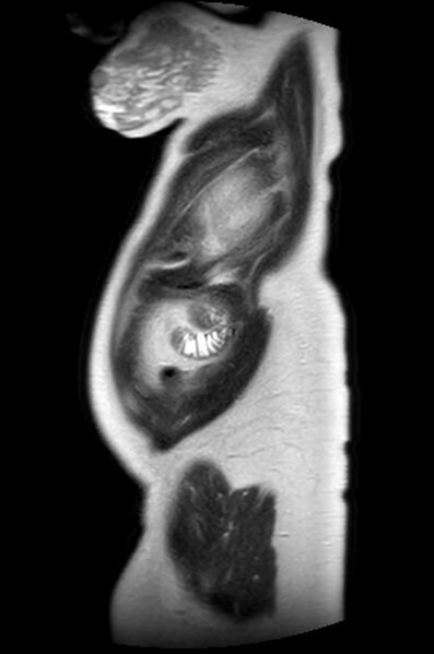 File:Appendicitis in gravida (MRI) (Radiopaedia 89433-106395 Sagittal T2 6).jpg
