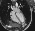 Arrhythmogenic right ventricular cardiomyopathy (Radiopaedia 39806-42237 D 75).jpg