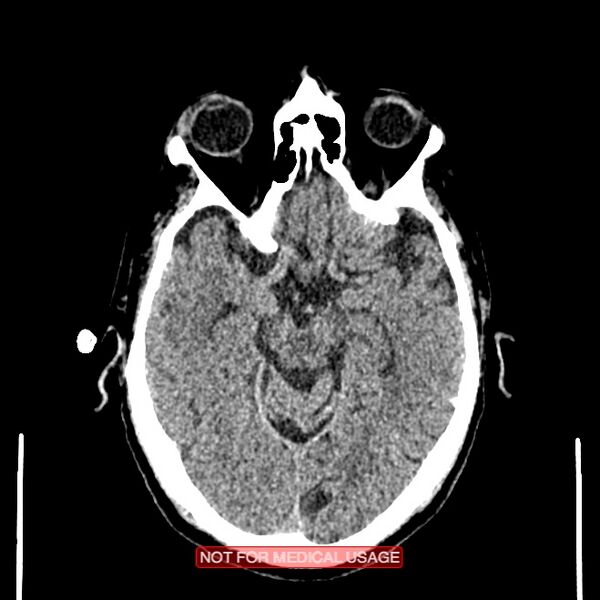 File:Artery of Percheron infarction (Radiopaedia 28679-28967 Axial non-contrast 47).jpg