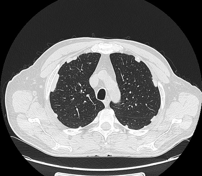 File:Asbestos pleural placques (Radiopaedia 57905-64872 Axial lung window 66).jpg