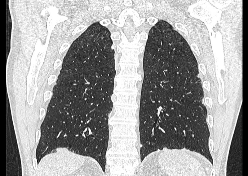 File:Asbestos pleural placques (Radiopaedia 57905-64872 Coronal lung window 225).jpg