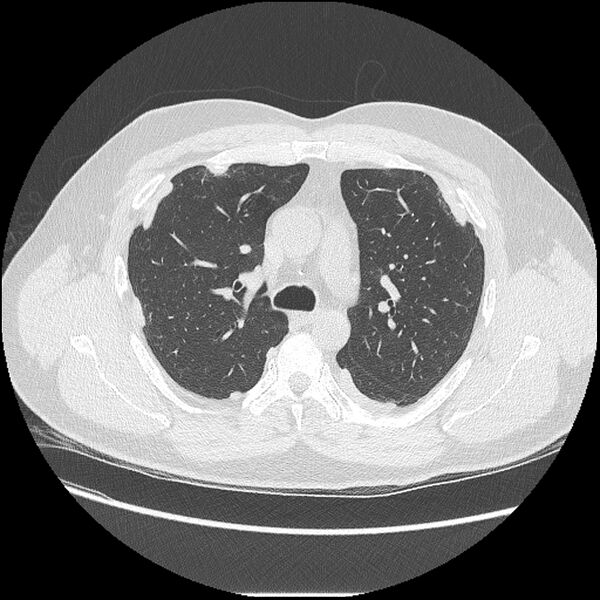 File:Asbestosis (Radiopaedia 45002-48961 Axial lung window 19).jpg