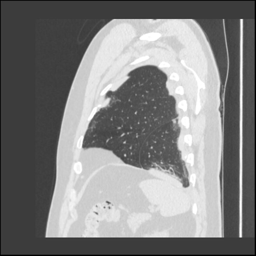 Asbestosis (Radiopaedia 45002-48961 Sagittal lung window 22).jpg
