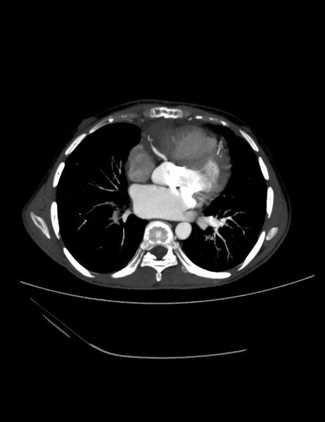File:Ascending aortic pseudoaneurysm (Radiopaedia 28638-28910 A 15).jpg