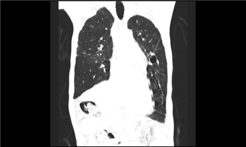 File:Aspergilloma (Radiopaedia 20788-20701 Coronal lung window 6).jpg