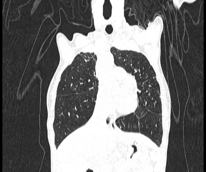 File:Aspergillomas (Radiopaedia 66779-76110 Coronal lung window 7).jpg