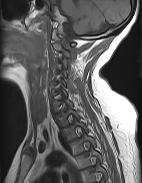 File:Astrocytoma - spinal cord (Radiopaedia 69769-79758 Sagittal T1 9).jpg