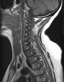 Astrocytoma - spinal cord (Radiopaedia 69769-79758 Sagittal T1 9).jpg