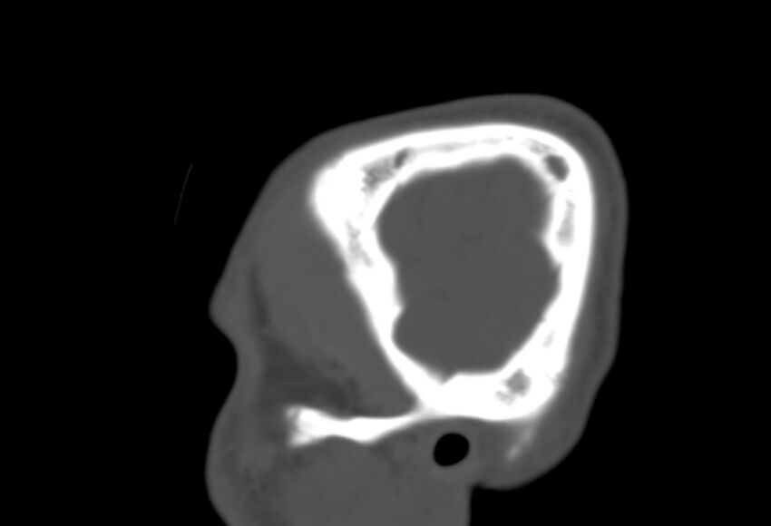 Asymptomatic occipital spur (Radiopaedia 87753-104201 Sagittal bone window 14).jpg