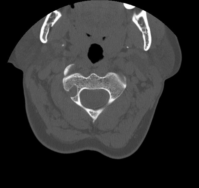 File:Atlanto-occipital assimilation with basilar invagination (Radiopaedia 70122-80188 Axial bone window 36).jpg