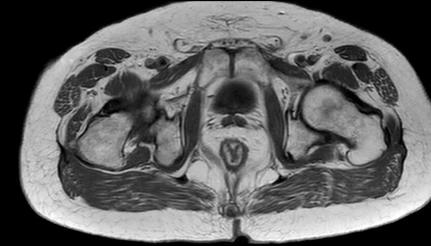 Atypical lipomatous tumor - thigh (Radiopaedia 68975-78734 Axial T1 89).jpg