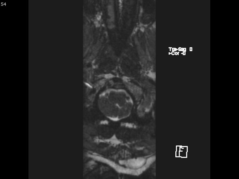 File:Atypical meningioma - intraosseous (Radiopaedia 64915-74572 Axial CISS 54).jpg