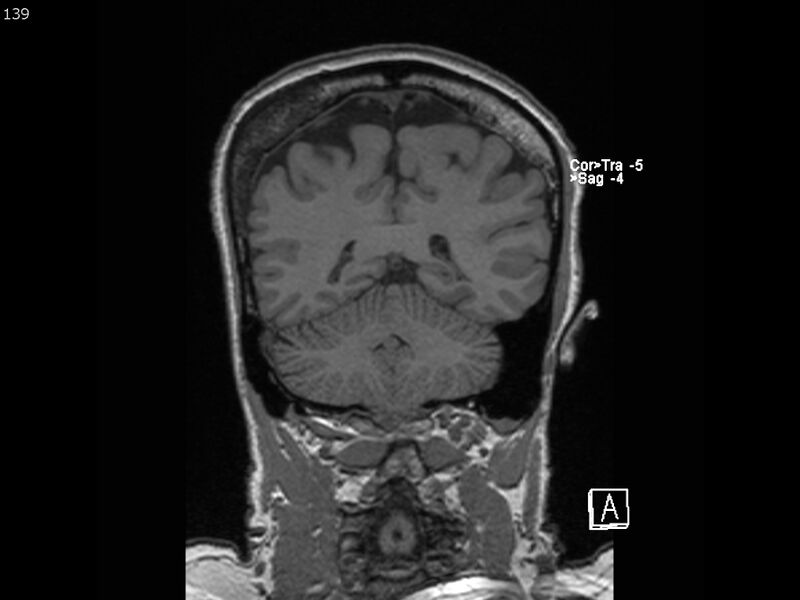 File:Atypical meningioma - intraosseous (Radiopaedia 64915-74572 Coronal T1 139).jpg