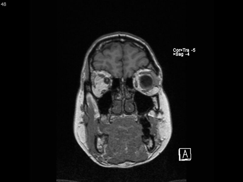 File:Atypical meningioma - intraosseous (Radiopaedia 64915-74572 Coronal T1 48).jpg