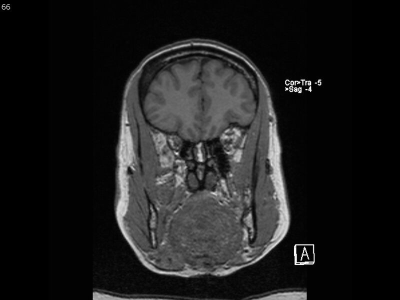 File:Atypical meningioma - intraosseous (Radiopaedia 64915-74572 Coronal T1 66).jpg
