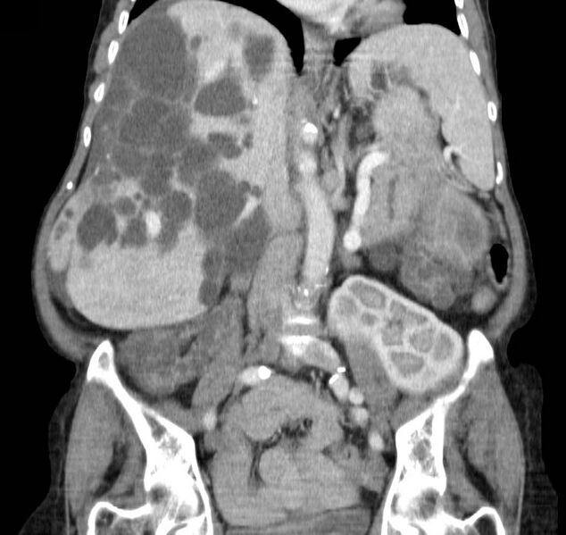 File:Autosomal dominant polycystic kidney disease (Radiopaedia 16777-16490 B 26).jpg