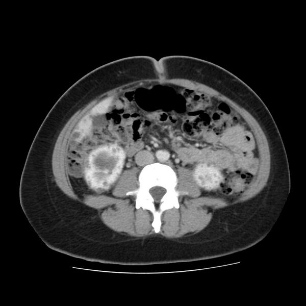 File:Autosomal dominant polycystic kidney disease (Radiopaedia 23061-23093 C 38).jpg