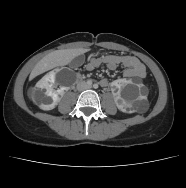 File:Autosomal dominant polycystic kidney disease - early onset (Radiopaedia 40734-43387 A 47).jpg