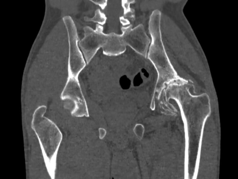 File:Avascular necrosis of the left hip (Radiopaedia 75068-86125 Coronal bone window 50).jpg