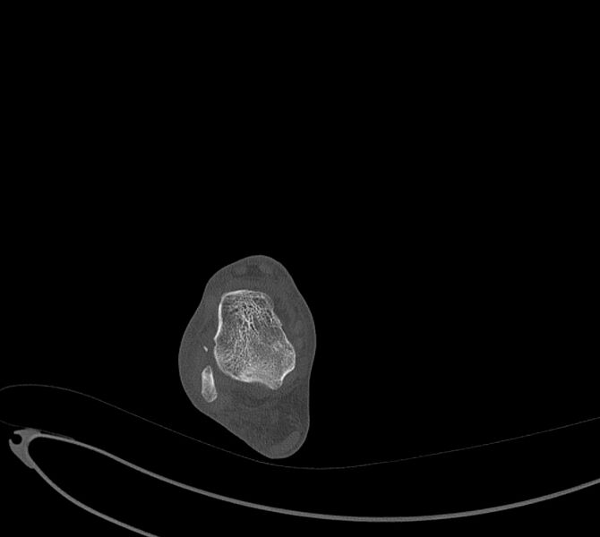 File:Avulsion fractures of talus and calcaneus (Radiopaedia 48277-53155 Axial bone window 27).jpg