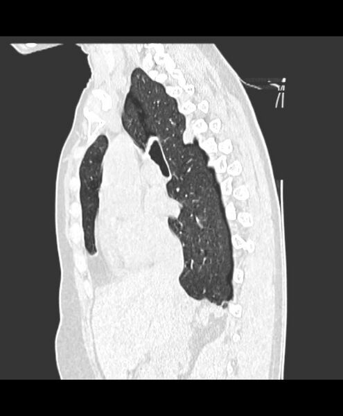 File:Azygos fissure and azygos lobe (Radiopaedia 41841-44832 Sagittal lung window 9).jpg