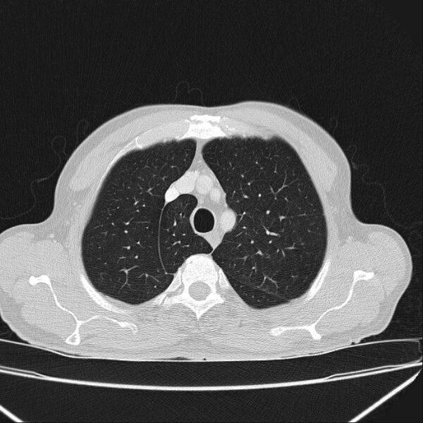 File:Azygos lobe (Radiopaedia 38259-40275 Axial lung window 16).jpg