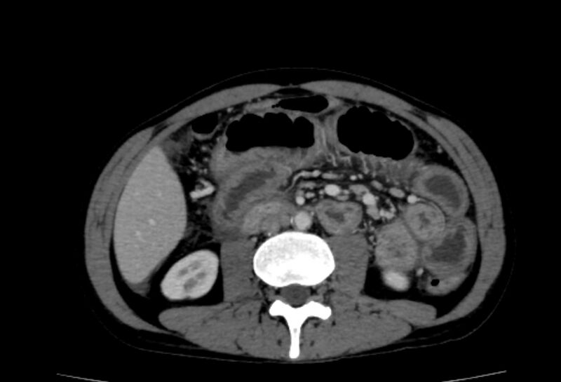 File:Behçet's disease- abdominal vasculitis (Radiopaedia 55955-62570 A 40).jpg