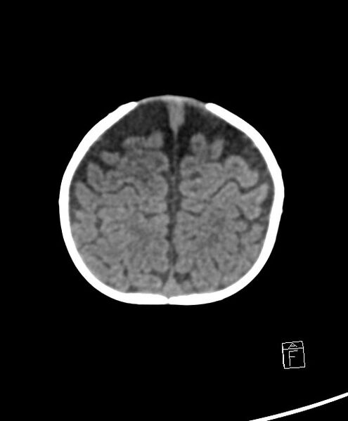 File:Benign enlargement of subarachnoid spaces in infancy (BESS) (Radiopaedia 87459-103795 Axial non-contrast 15).jpg