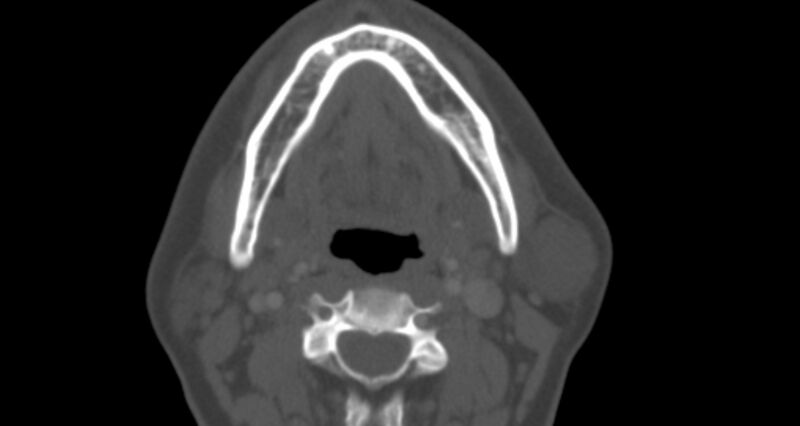 File:Benign mixed salivary tumor of the parotid gland (Radiopaedia 35261-36792 Axial bone window 24).jpg