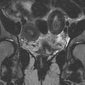 Bicornuate uterus (Radiopaedia 24677-24949 Coronal T2 5).jpg