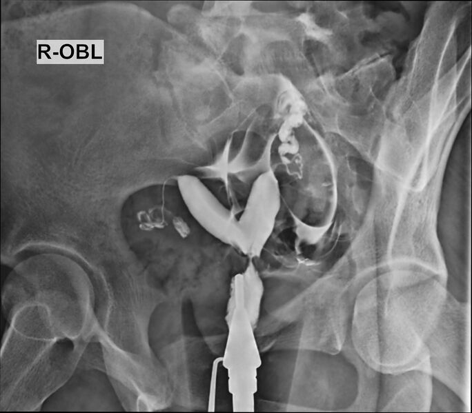 File:Bicornuate vs septate uterus (Radiopaedia 62784-71120 E 1).jpg