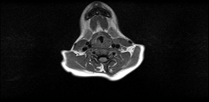 File:Bilateral Sprengel deformity with Klippel-Feil syndrome (Radiopaedia 66395-75650 Axial T1 13).jpg