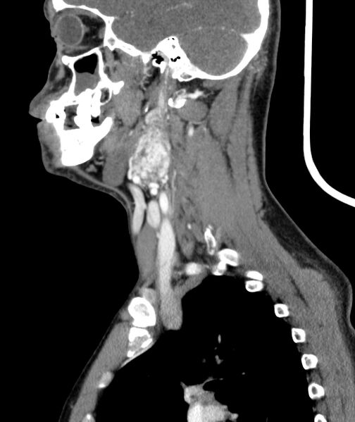 File:Bilateral carotid body tumors (Radiopaedia 52899-58827 C 12).jpg