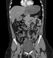 Bilateral ovarian mature cystic teratomas (Radiopaedia 79373-92457 B 20).jpg