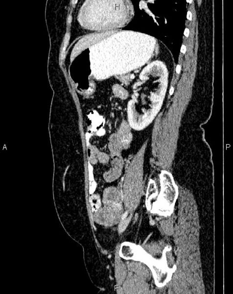 File:Bilateral ovarian serous cystadenocarcinoma (Radiopaedia 86062-101989 E 59).jpg