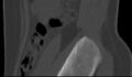 Bilateral pars defect (Radiopaedia 26691-26846 Sagittal bone window 1).jpg