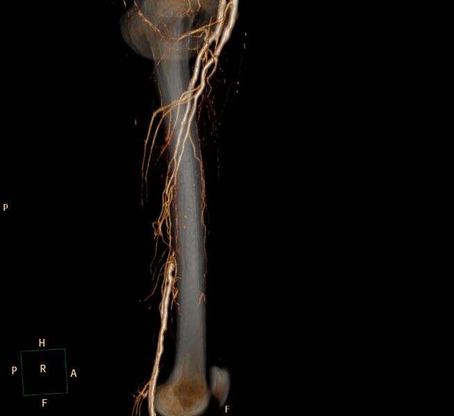 File:Bilateral superficial femoral arterial occlusion (Radiopaedia 25682-25857 3D VR 6).jpg