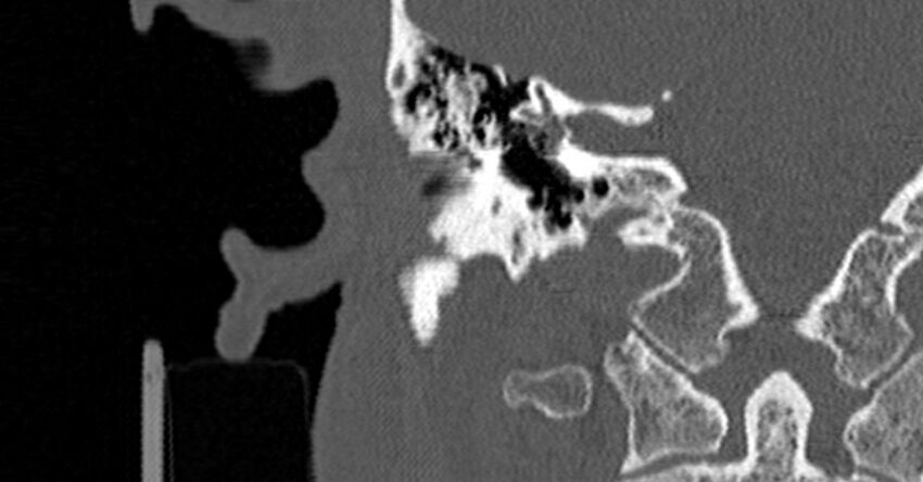 Bilateral temporal bone fractures (Radiopaedia 29482-29970 Coronal non-contrast 112).jpg